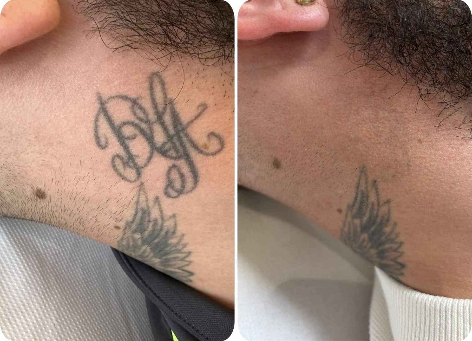 Détatouage Laser - Après 5 séances