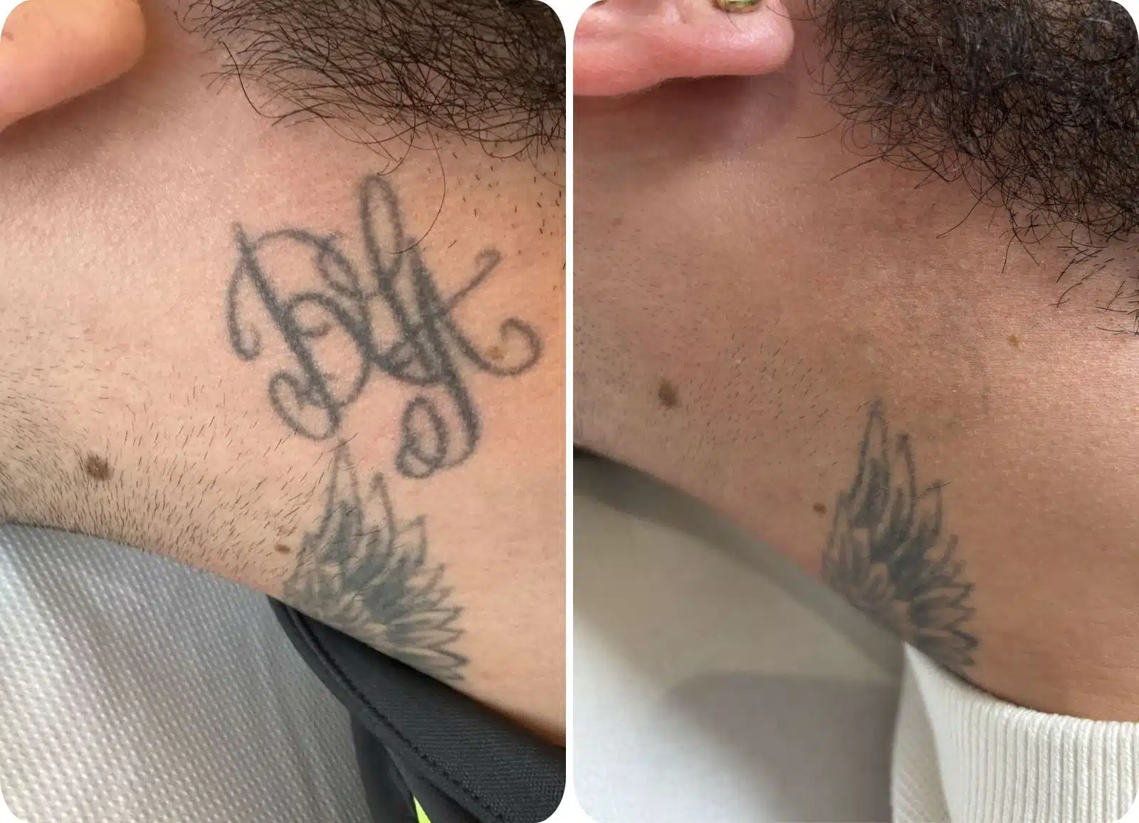 Détatouage Laser - Après 5 séances