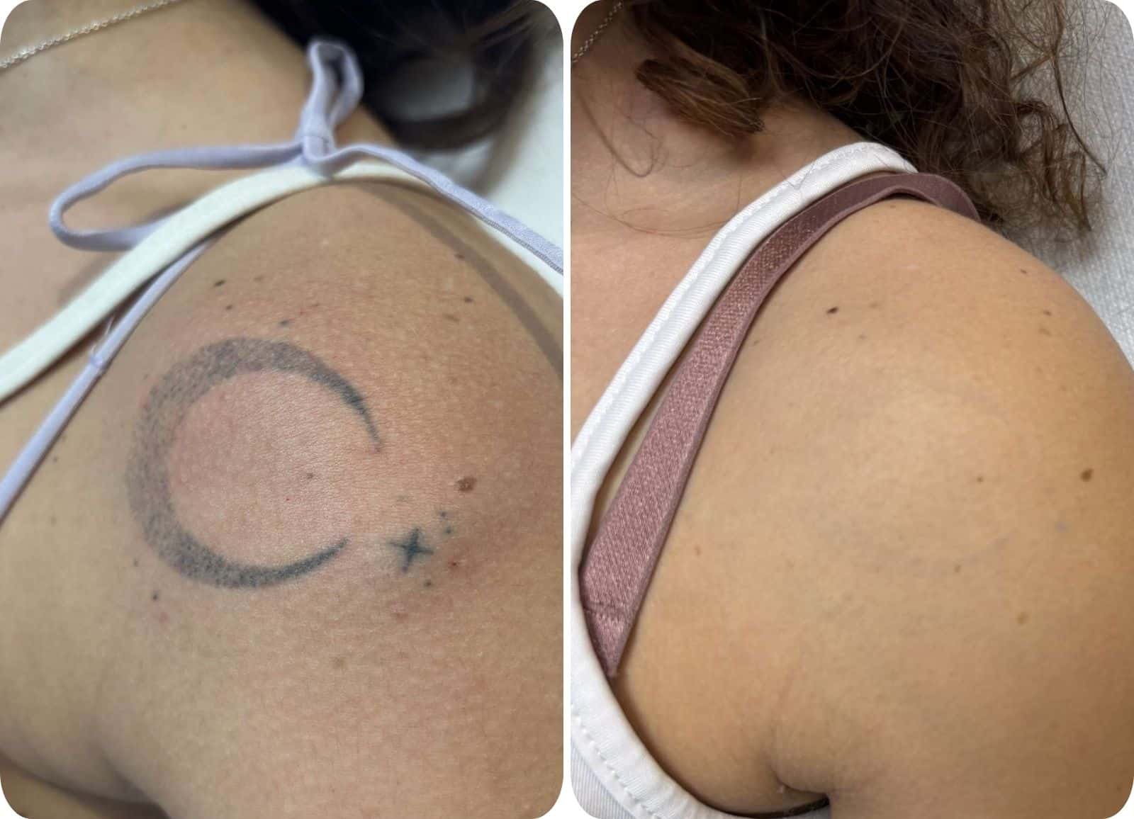 Détatouage - Après 4 séances