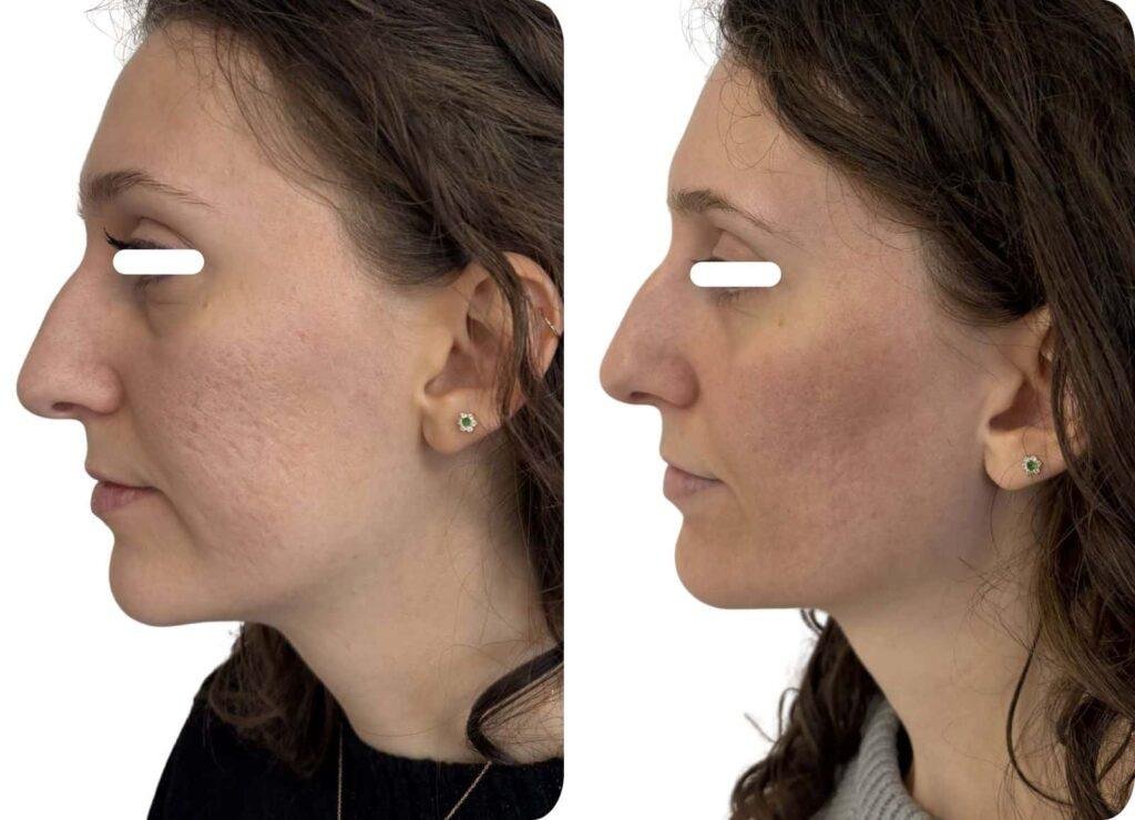 Avant/après laser Fraxel sur des cicatrices d'acné, après 5 séances