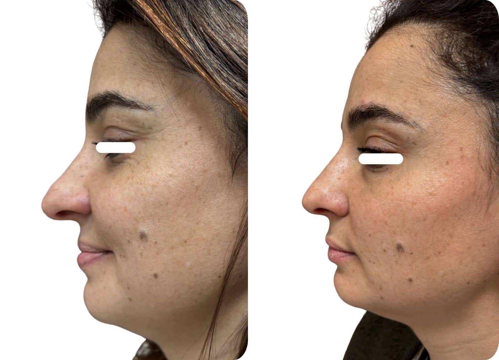 Rhinoplastie médicale - Acide hyaluronique