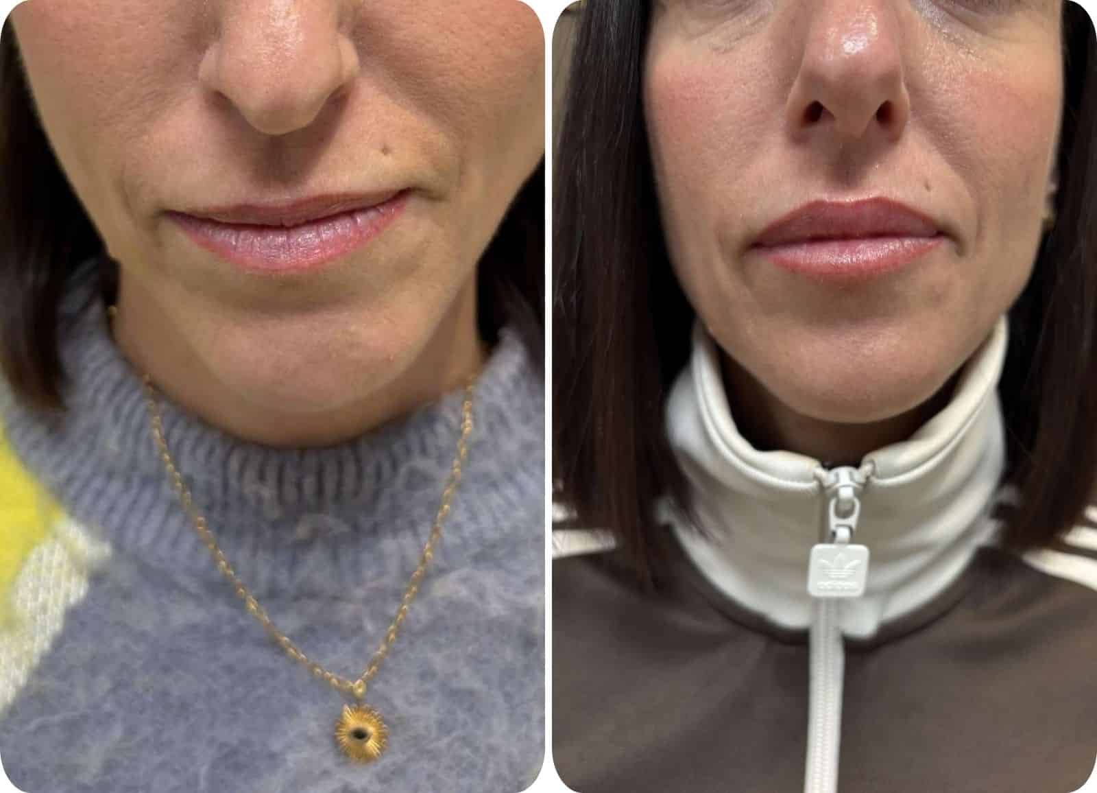 Lèvres - Acide hyaluronique