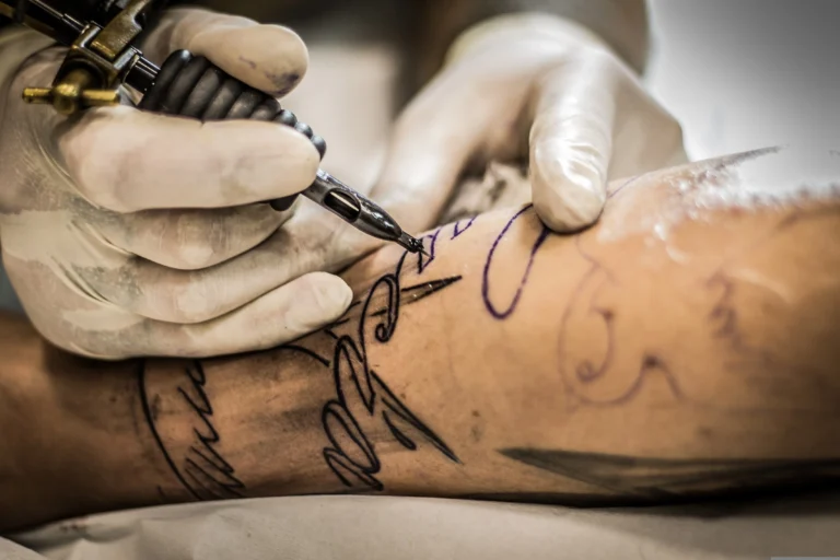 Risque detatouage laser