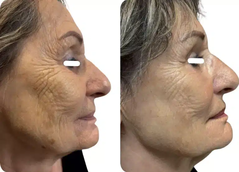 Avant et après : Visage (Radiesse®, 2 séances)