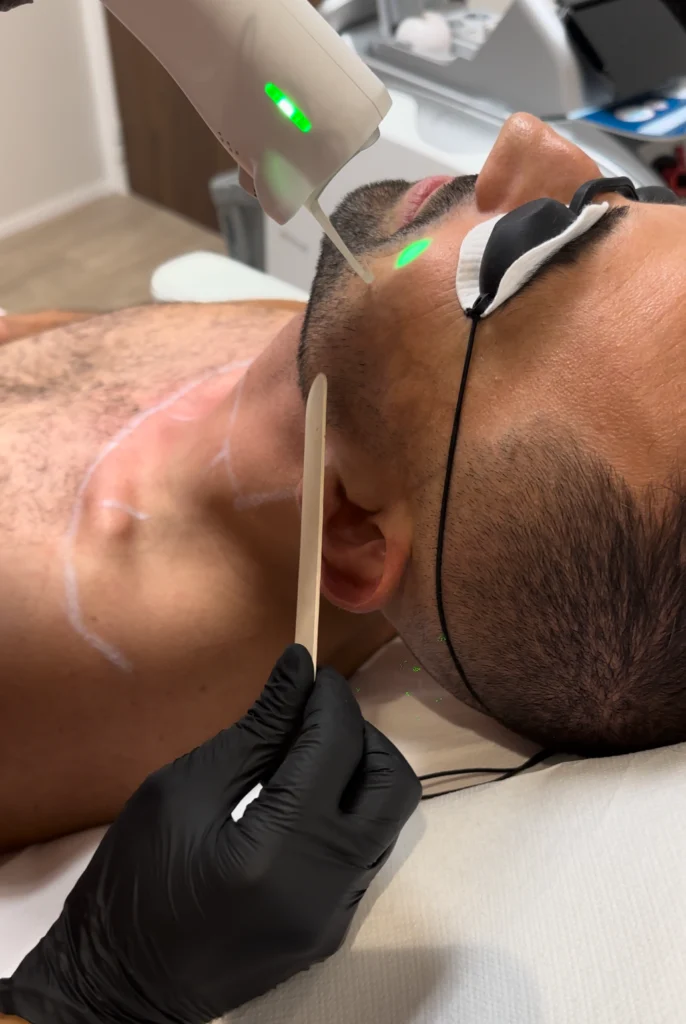 épilation laser visage