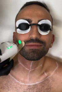 résultat épilation laser visage