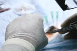 Mains gantées préparant des greffons capillaires à la pince