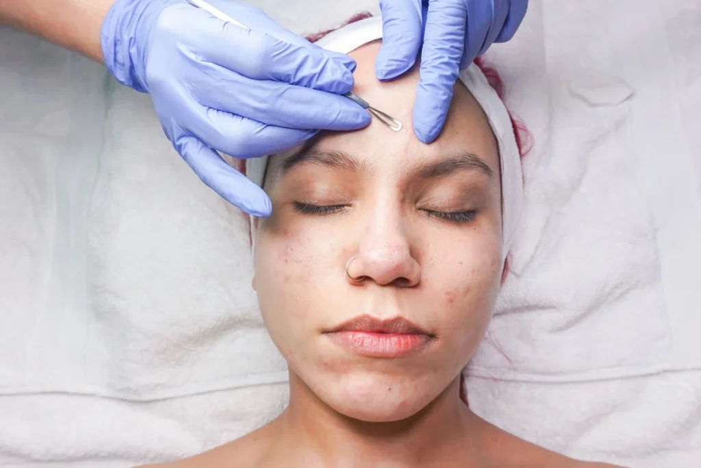 Soin du visage sur une peau à tendance acnéique