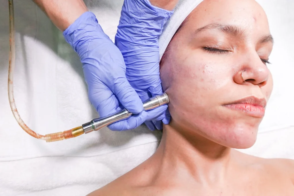 Rougeurs du visage pendant un soin par micro-aiguilles